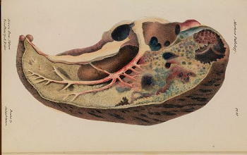 Killing your character convincingly – Lung Abscess